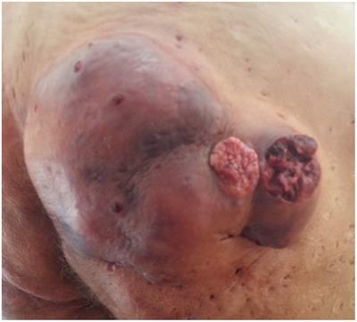 Multiple verrucous squamous cell carcinomas developing on chronic hidradenitis suppurativa lesions—a rare case report from Romania